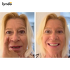 EYELIFT | ONZICHTBARE PERFECTIE VOOR OOGLIFT